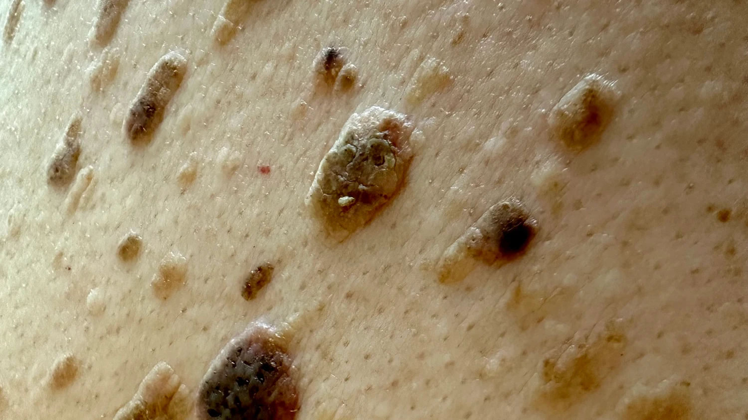 Primer plano de queratosis seborreica