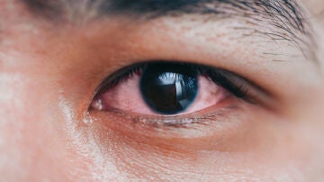 Un hombre con el ojo rojo