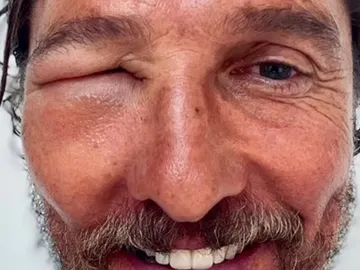 Matthew McConaughey tras picarle una abeja en la cara Matthew McConaughey tras picarle una abeja en la cara