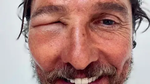 Matthew McConaughey tras picarle una abeja en la cara Matthew McConaughey tras picarle una abeja en la cara