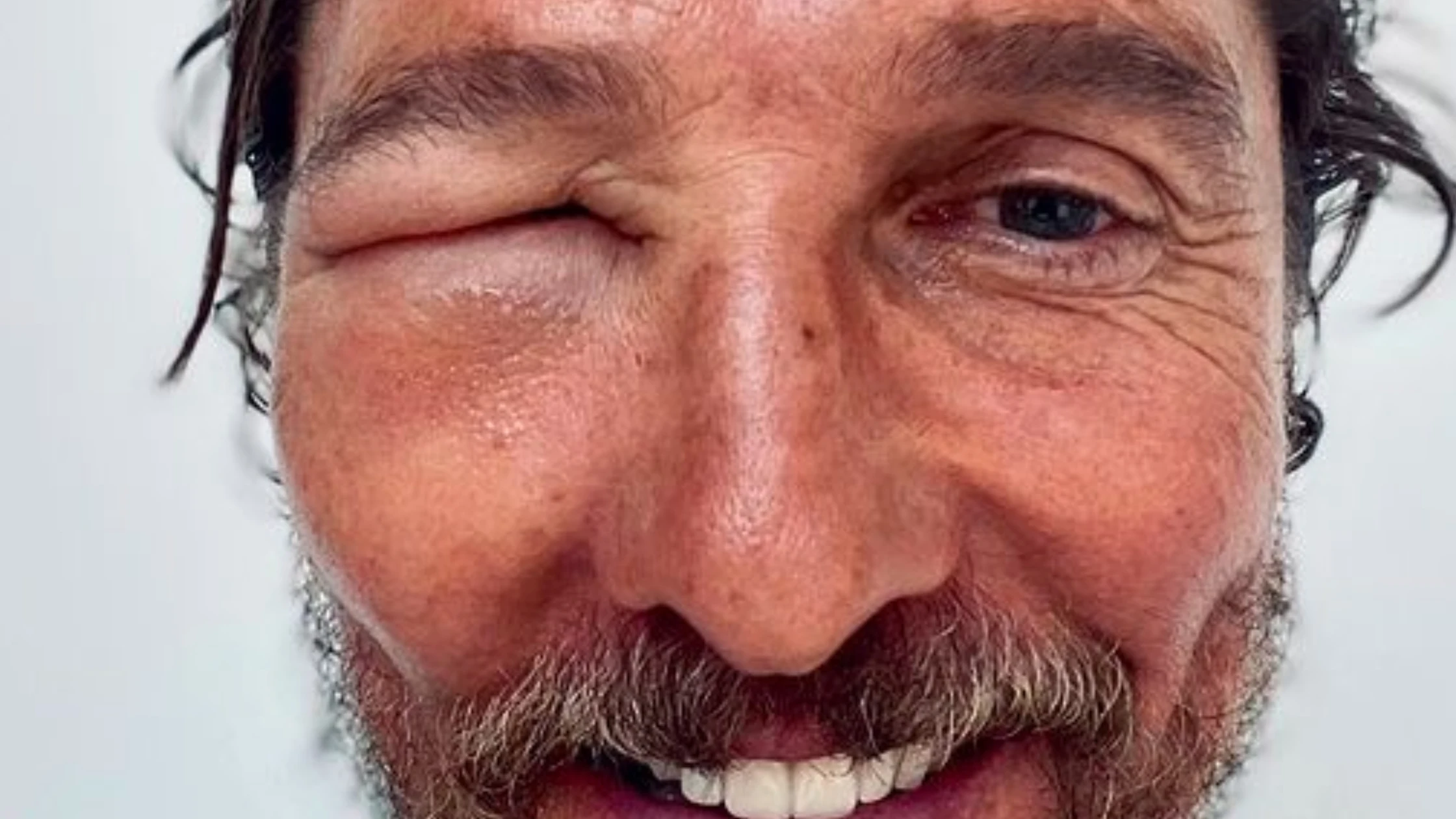 Matthew McConaughey tras picarle una abeja en la cara Matthew McConaughey tras picarle una abeja en la cara