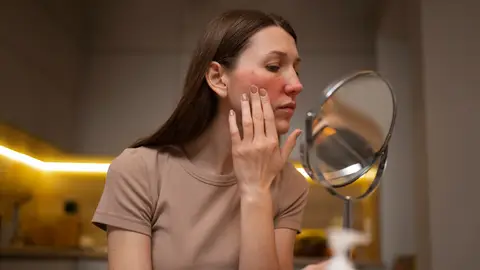 Mujer con rojeces en el rostro Mujer con rojeces en el rostro