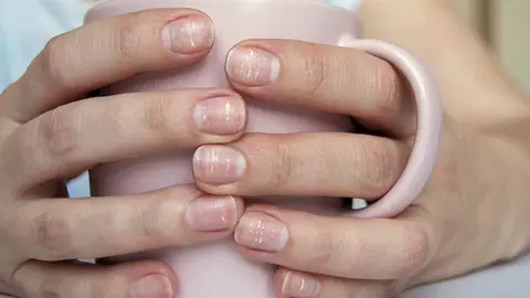 Uñas con manchas blancas Uñas con manchas blanca