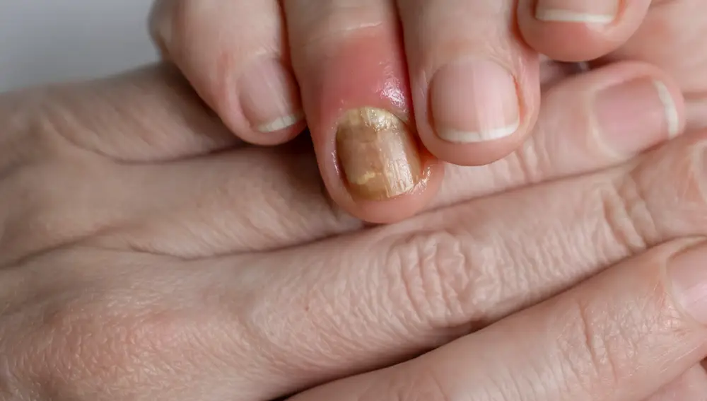Uña con mancha amarilla Uña con mancha amarilla