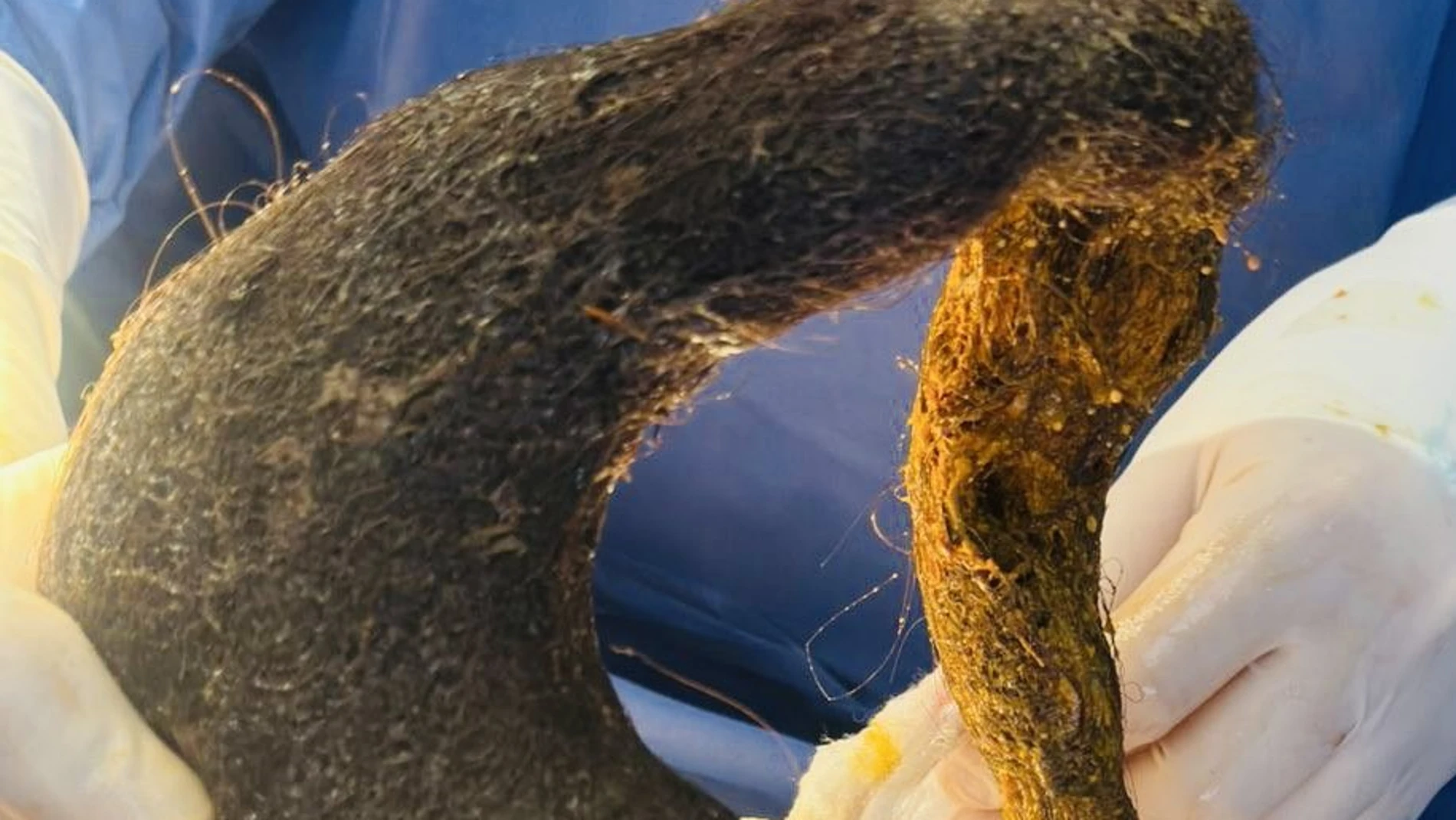 La bola de pelo gigante del estómago de una joven La bola de pelo gigante del estómago de una joven