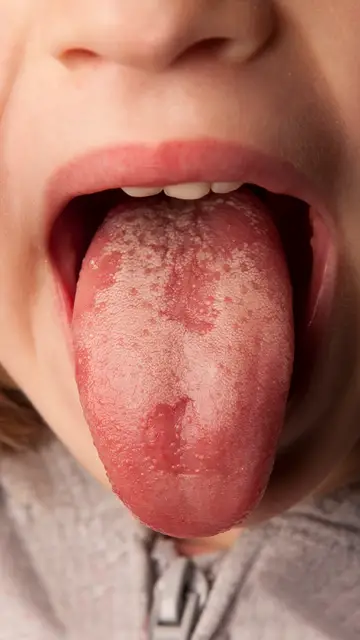 Lengua geográfica Lengua geográfica