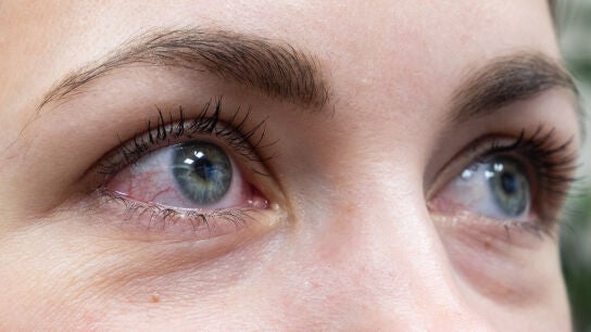 Ojos irritados