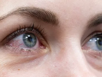 Ojos irritados Ojos irritados