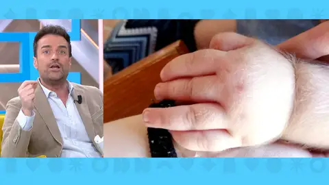 bebés, síndrome hombre lobo bebés, síndrome hombre lobo