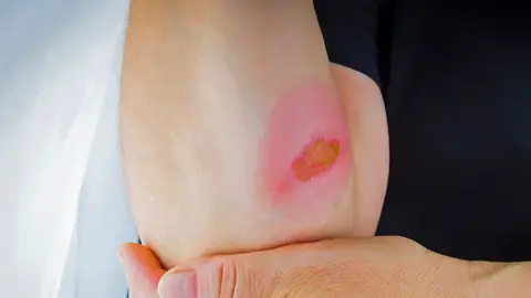 Quemadura en el brazo Quemadura en el brazo