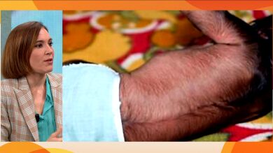 Del síndrome del hombre lobo al de la piel azul: Boticaria García desvela qué fármacos alteran nuestro aspecto físico