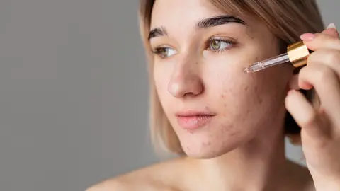 Mujer con acné Mujer con acné