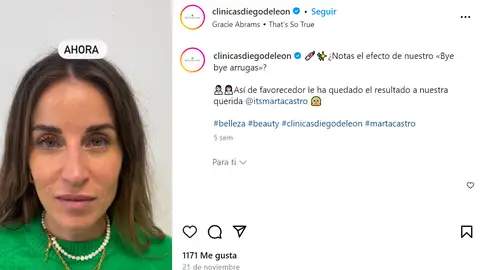 Marta Castro tras el tratamiento Bye bye arrugas Marta Castro tras el tratamiento Bye bye arrugas