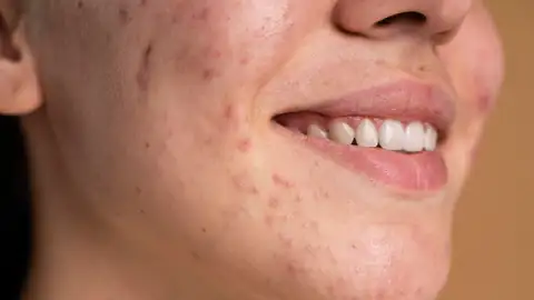 Rostro con acné Rostro con acné