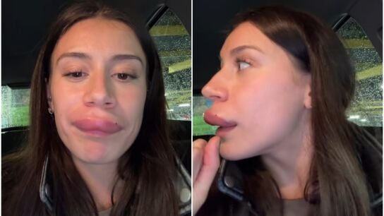 Sara, la joven tiktoker que muestra las secuales de usar &aacute;cido hialur&oacute;nico
