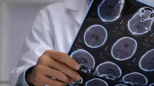 Alzheimer Detectan cambios en regiones cerebrales clave en el alzheimer en individuos con alta carga patologica en sangre
