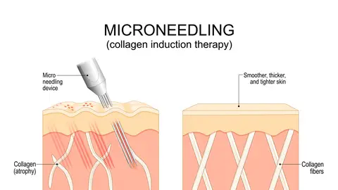 Funcionamiento del microneedling Funcionamiento del microneedling