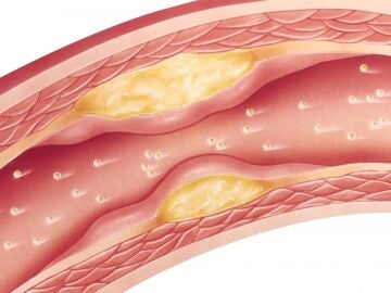 Imagen de adherencias en las arterias, colesterol. 