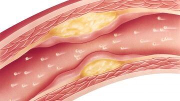 Imagen de adherencias en las arterias, colesterol. 
