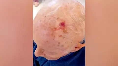 Heridas de un anciano en una residencia de Valladolid Heridas de un anciano en una residencia de Valladolid