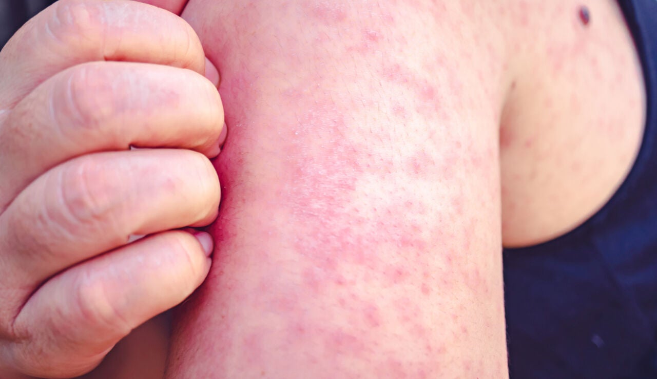 S&iacute;ntomas del sarampi&oacute;n