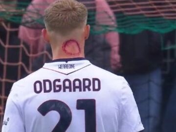 Jens Odgaard, futbolista del Bolonia, y su extraña marca en el cuello