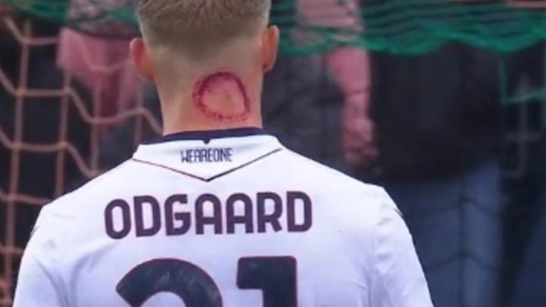 Jens Odgaard, futbolista del Bolonia, y su extraña marca en el cuello Jens Odgaard, futbolista del Bolonia, y su extraña marca en el cuello