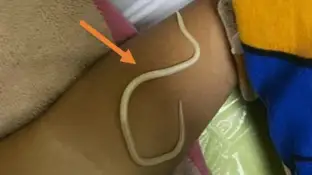 Imagen de uno de los gusanos encontrados Imagen de uno de los gusanos encontrados