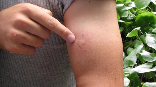 Picadura de mosquito Picadura de mosquito