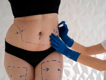 Preparaci&oacute;n de una liposucci&oacute;n