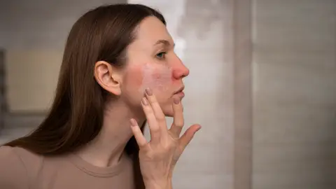 Mujer con rosácea Mujer con rosácea