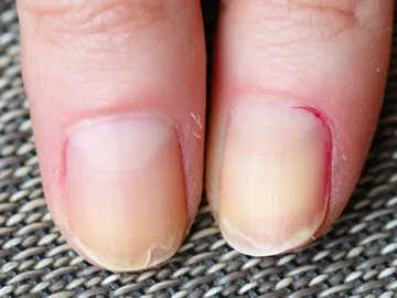 Uñas rotas Uñas rotas