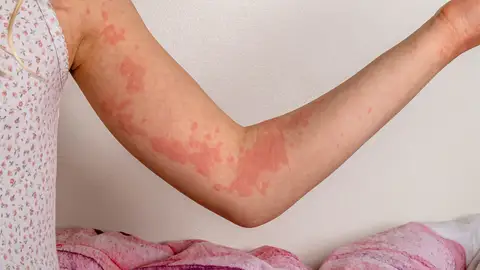 Sarpullido en la piel Sarpullido en la piel