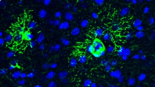 Una prote&iacute;na podr&iacute;a anticipar el alzh&eacute;imer