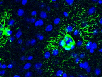 Una proteína podría anticipar el alzhéimer