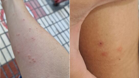 Picaduras en el Hospital Regional de M&aacute;laga
