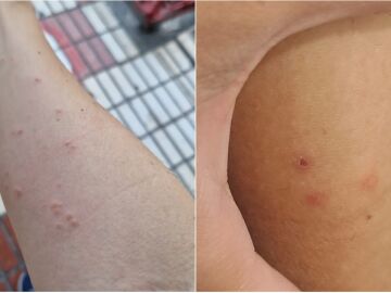 Picaduras en el Hospital Regional de Málaga