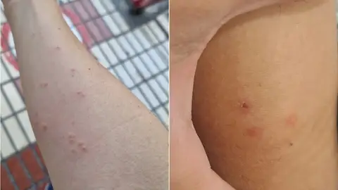 Picaduras en el Hospital Regional de Málaga Picaduras en el Hospital Regional de Málaga