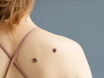 Mujer con lunares en la espalda Mujer con lunares en la espalda