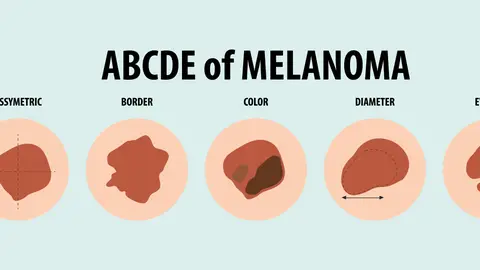 Regla ABCDE del melanoma Regla ABCDE del melanoma