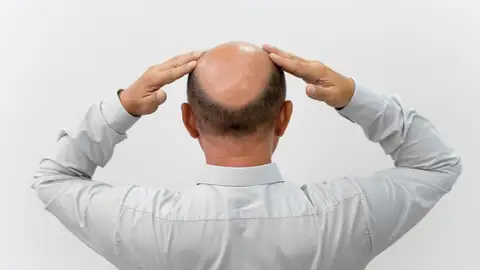 Imagen de un hombre calvo con las manos en la cabeza Imagen de un hombre calvo con las manos en la cabeza