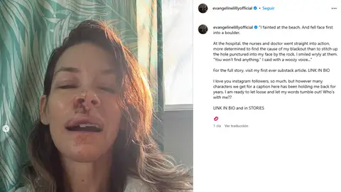 Evangeline Lilly muestra su aparatoso accidente Evangeline Lilly muestra su aparatoso accidente