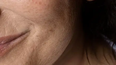 Pigmentación de la piel Pigmentación de la piel