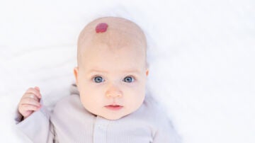 Bebé con hemangioma
