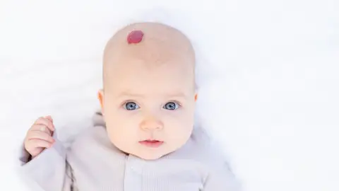Bebé con hemangioma Bebé con hemangioma
