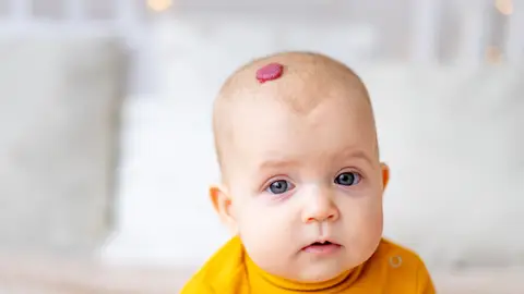 Bebé con hemangioma Bebé con hemangioma