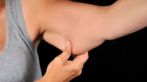 Flacidez en la parte inferior del brazo Flacidez en la parte inferior del brazo