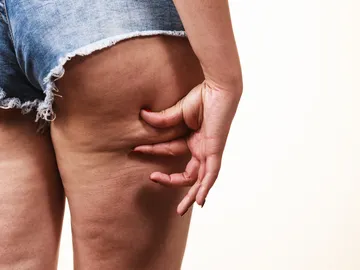 celulitis celulitis