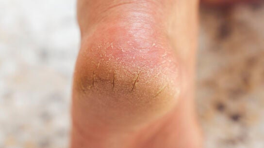 Talones agrietados