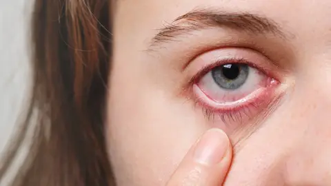 Ojo enrojecido Ojo enrojecido